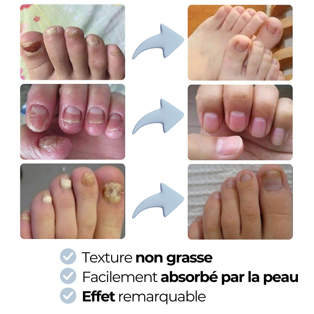 Gel antifongique postur