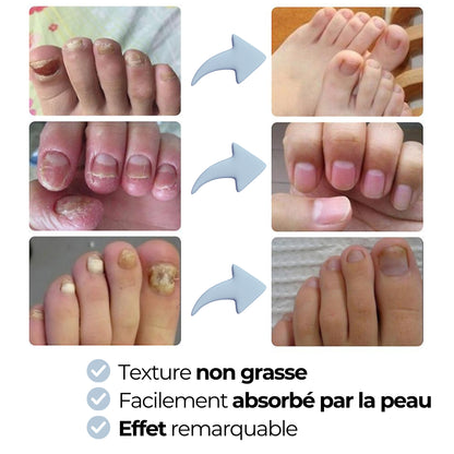 Gel antifongique postur