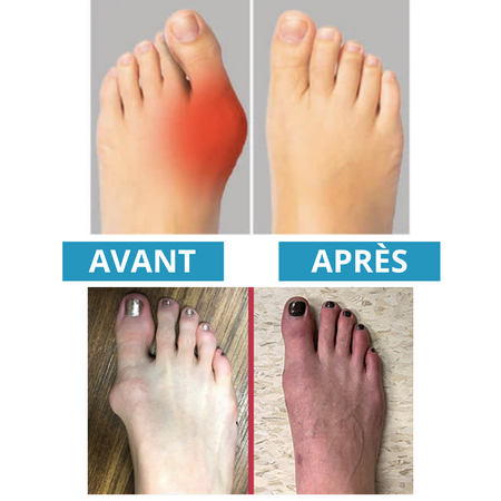 Sandales orthopédiques pour les oignons