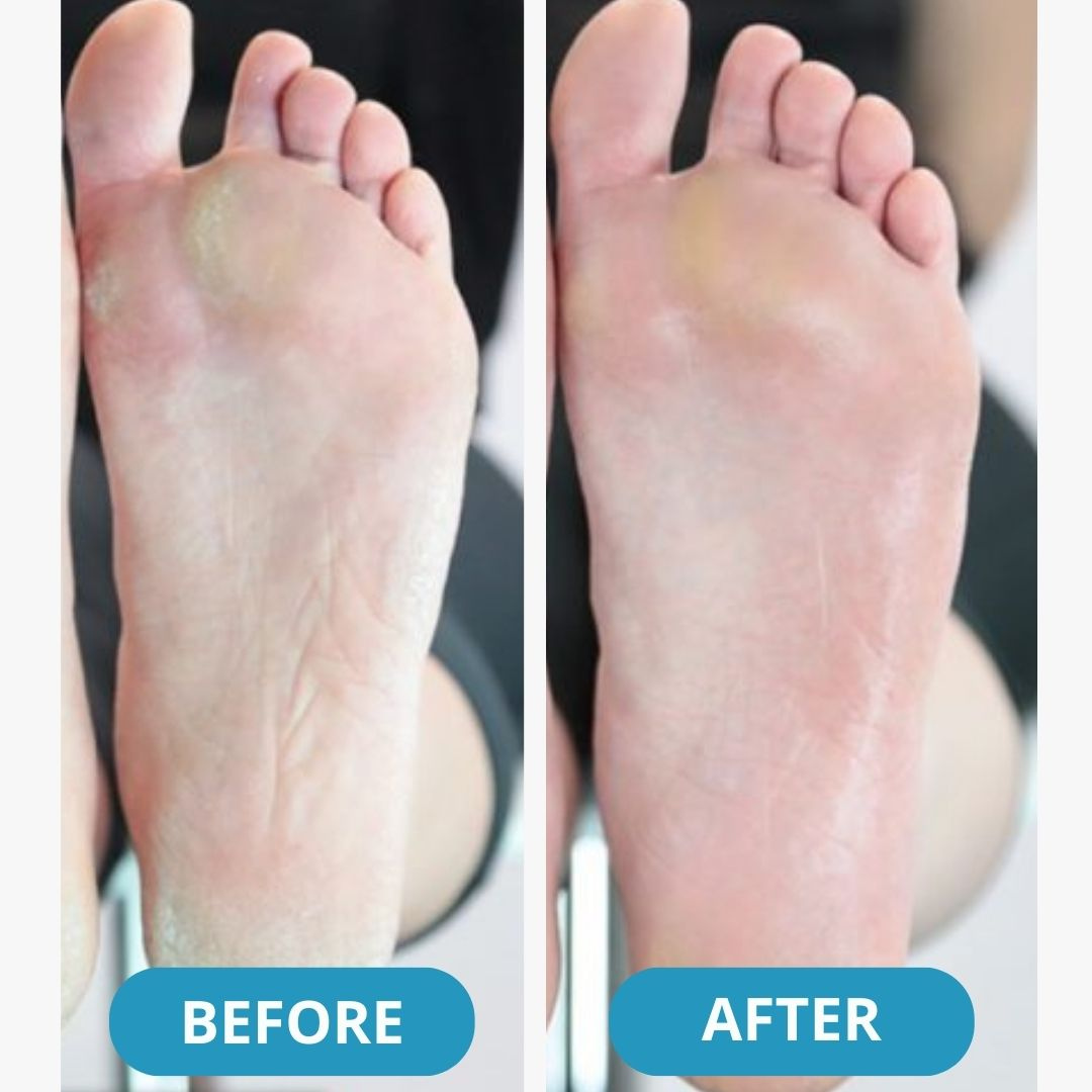 Orthopedic Air Sneakers - Experience Lasting Foot Pain Relief